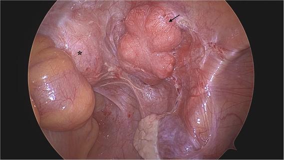 Intra-operative right retroperitoneal pelvic mass
