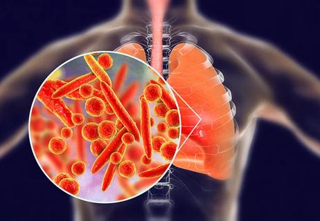 Mycoplasma pneumoniae bacteria in human lungs, 3D illustration.