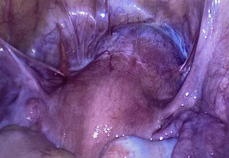 Laparoscopic image revealing a cesarean section scar ectopic pregnancy at 9+5 weeks gestation.