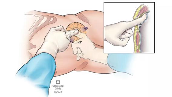 Drawing of surgeon's fingers pressing into a patient's body