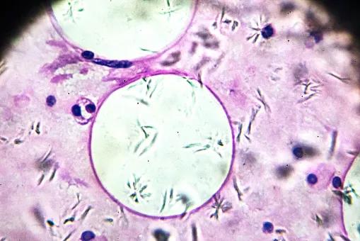 Liposarcoma biopsy under microscopy zoom in different ranges