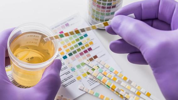 Gloved hands holding cup of urine sample, testing it