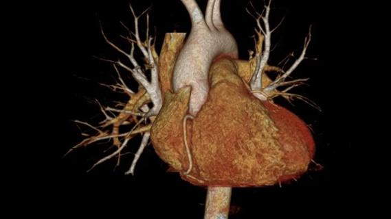 color scan of the aorta entering the heart