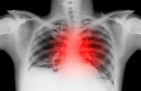 X-ray of lung with heart attack