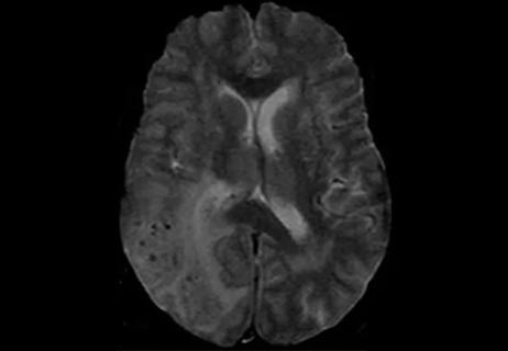 brain MRI showing inflammation related to cerebral amyloid angiopathy