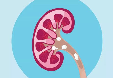 Illustration of kidney stones leaving kidney