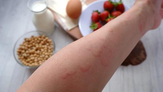 Hives on forearm, with possible allergy trigger foods on table, nuts, milk, eggs strawberries