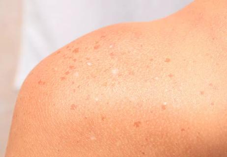 A person's bare shoulder showing white spots from sun exposure