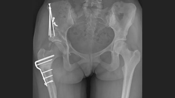 An X-ray of a patient's hips, showing opaque bones with bright white pins in them