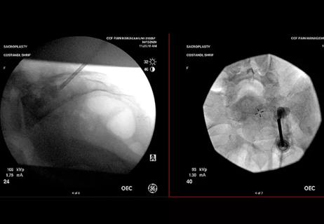 Antero-posterior and lateral images of sacroplasty technique
