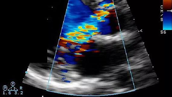 echocardiogram showing severe aortic regurgitation