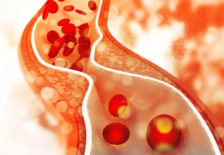 Cholesterol plaque in artery restricting blood flow