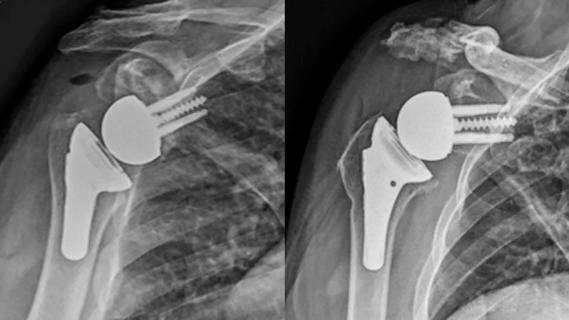 X-rays of total shoulder replacement
