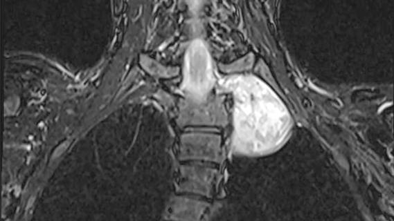 Nerve tumour in a patient's chest