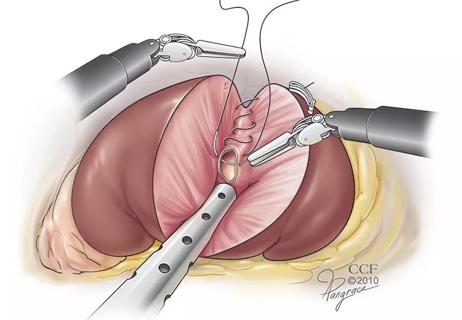 650&#215;450-partial-nephrectomy