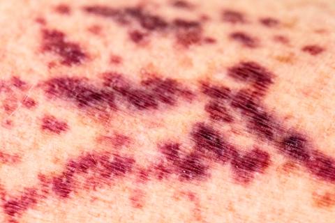 vasculitis rash