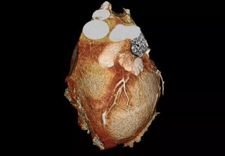 CT angiogram showing myocardial bridging