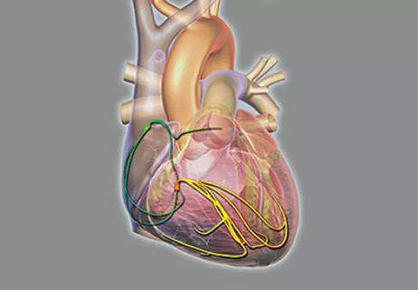 Cleveland Clinic Garners $3.7M AHA Award to Probe Atrial Fibrillation Prevention