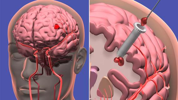 Cleveland-Clinic-Deep-Brain-Bleed