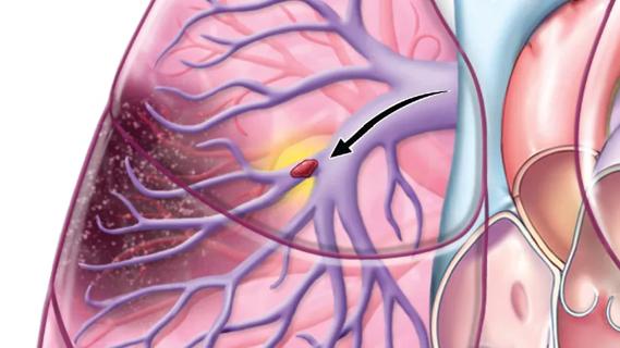 clot in a lung passageway with an arrow pointing at it