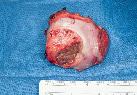 Figure 2. Soft palate tumor excised