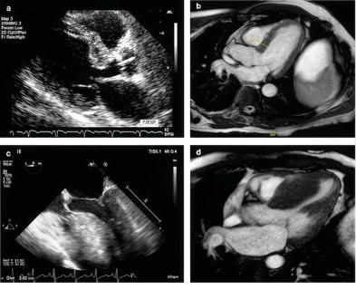 Surgical Treatment of Hypertrophic Cardiomyopathy