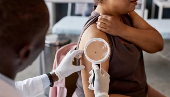 melanoma exam