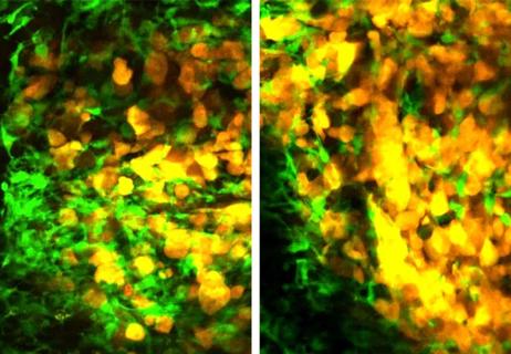 18-NEU-5864_glioblastoma-sex-differences_650x450