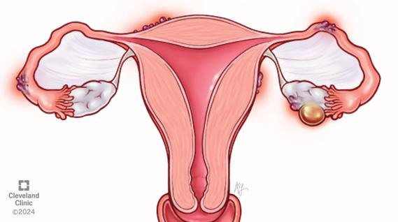 Endometriosis illustration