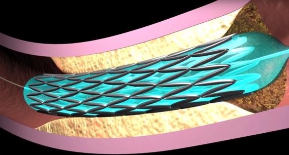 absorbable stent