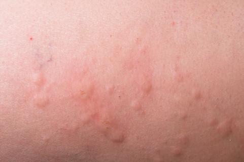 Close-up of rash on skin