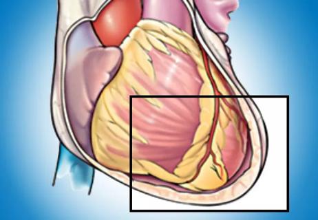 19-HRT-6045-pericarditis-650&#215;450