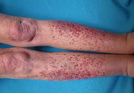 21-RHE-2051461&#8211;Brown_Vasculitis-somethingMore-caseStudy-CQD_650x450