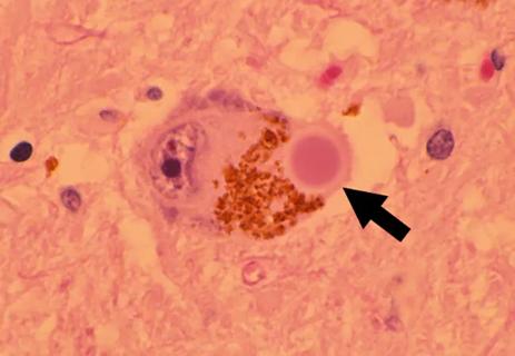 histopathology image with pink background and arrow pointing to round cell