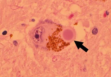 pathology image of a Lewy body inclusion
