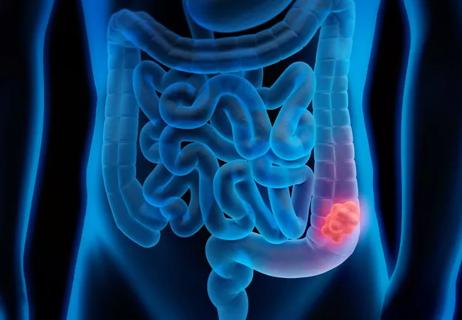 Illustration of colorectal cancer