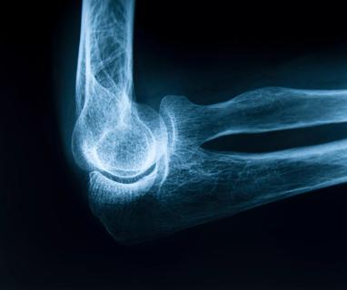 osteoporosis_650x450