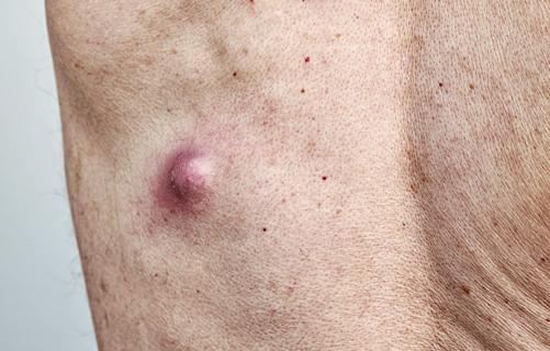 Large red bump under the skin on a back