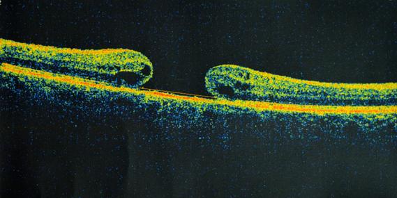Macular hole