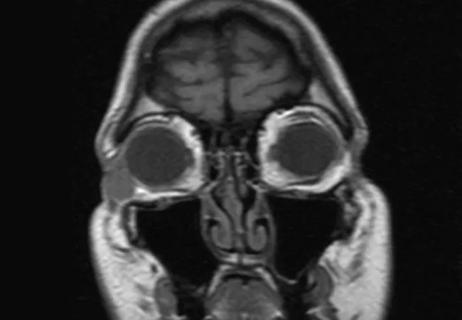 Orbital Nodular Fasciitis in an Adult Misdiagnosed as Sarcoma