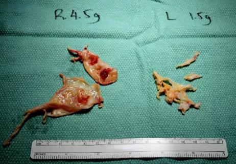 650&#215;450-Chronic-thromboembolic-pulmonary-hypertension