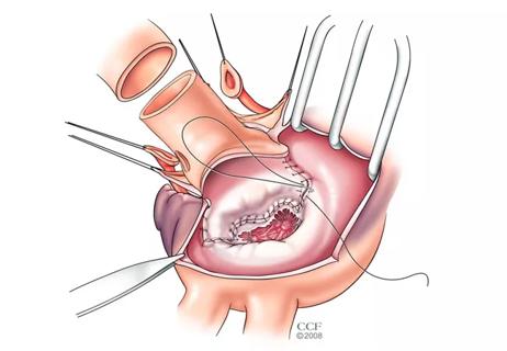 The Hemi-Commando Arrives: A New Technique for Double-Valve Endocarditis