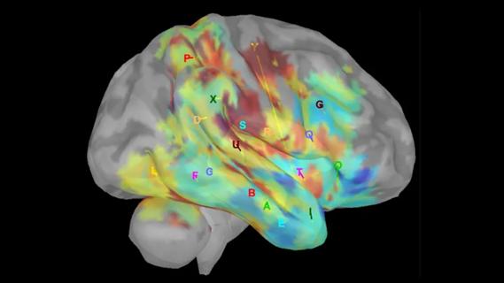 Electrophysiological brain activity of a patient during an experimental sensory-motor neurorehabilitation task for epilepsy.