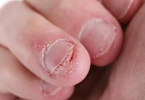 Closeup of fingernails bitten down to the quick.