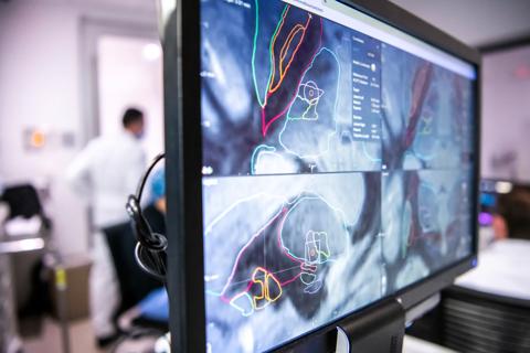 deep brain stimulation of dentate nucleus