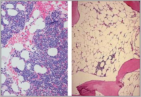 650&#215;450-Normal-marrow-and-aplastic-marrow-comparison