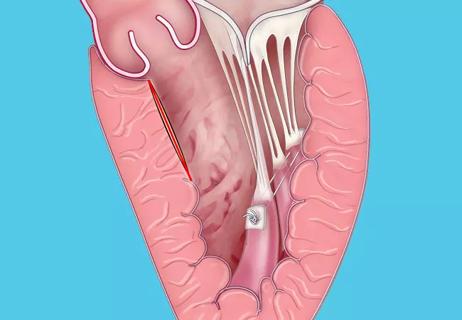 20-HVI-1941484_robotic-myectomy-mitral-valve-repair_650x450