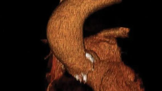 image showing a bulge in the ascending aorta of the heart