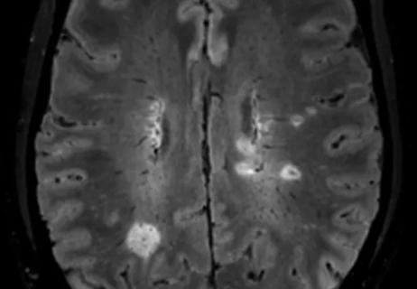 brain MRI showing central vein sign