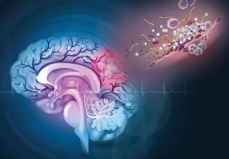 anatomic illustrations of a stroke and of endocarditis pathogenesis